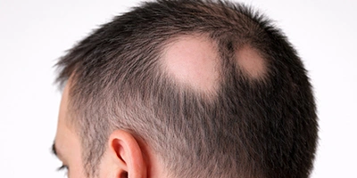 Patchy Hair Loss – Alopecia Areata